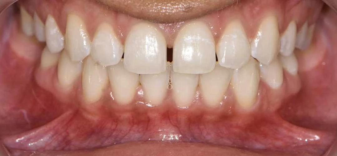 Photo showing anterior view of a patient's teeth before braces treatment with Dr. Karam Kharsa
