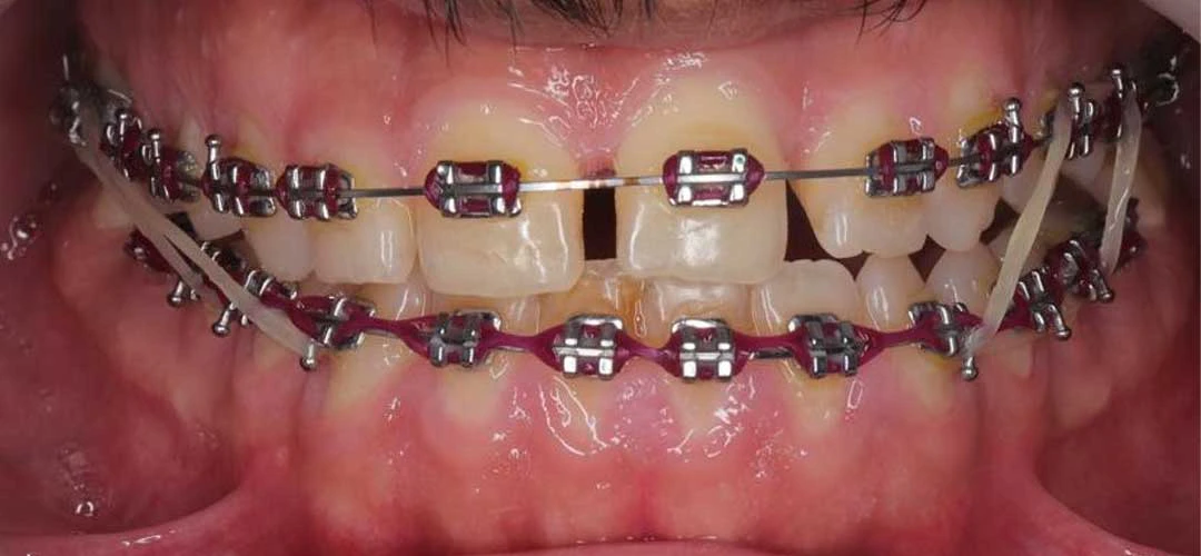 Photo showing teeth of a patient before braces treatment with Dr. Karam Kharsa