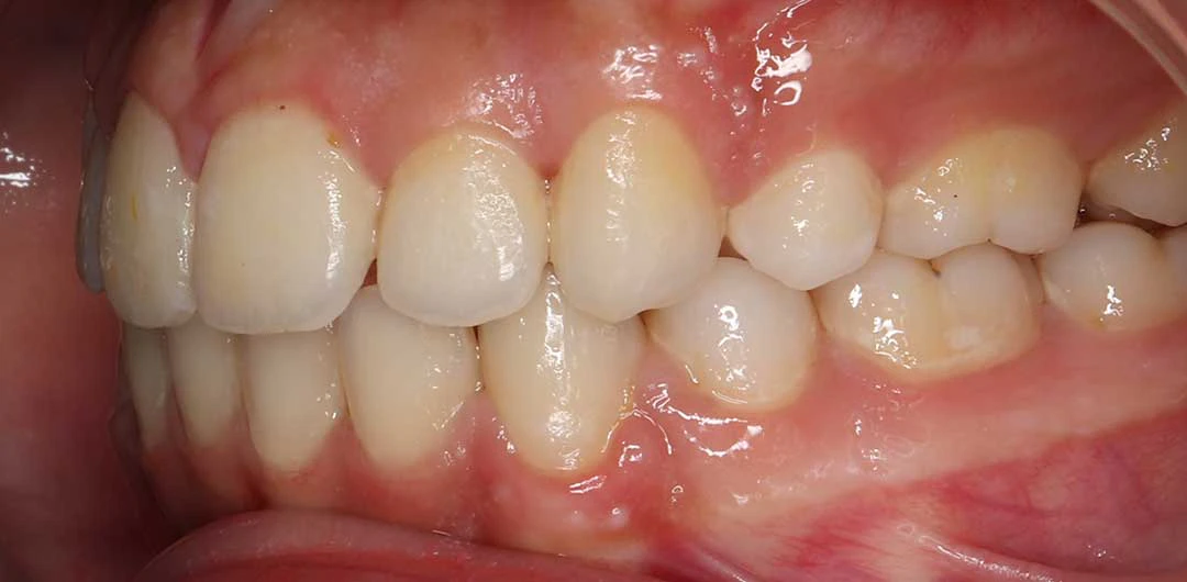 Photo showing teeth of a patient after braces treatment with Dr. Karam Kharsa