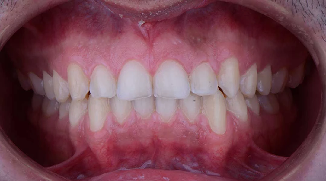 After Invisalign Treatment