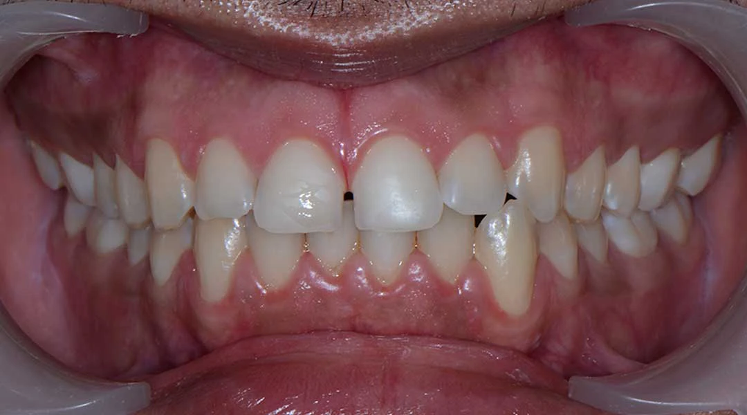 Before Invisalign Treatment
