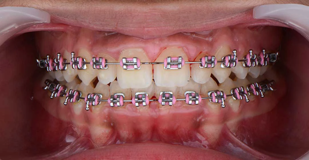 Final phase dental treatment with braces