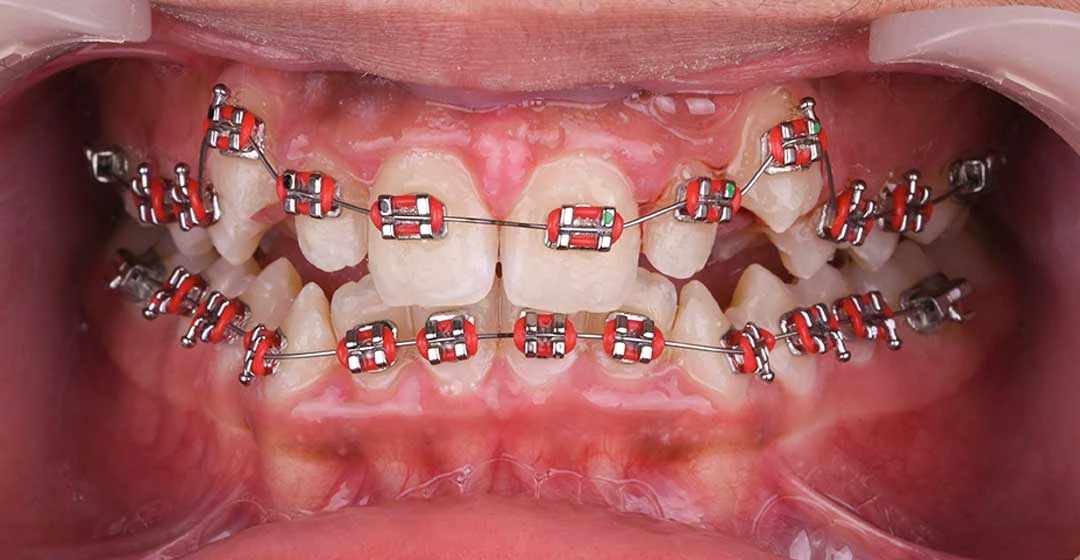 Close-up photo of a patient’s mouth before starting treatment with dental braces at Harmony Medical Center.