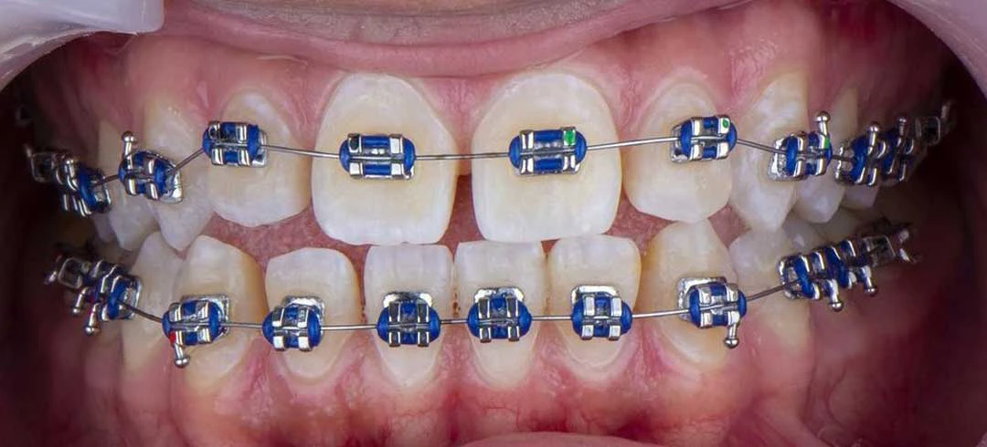 A closeup of the mouth showing a patient with dental braces