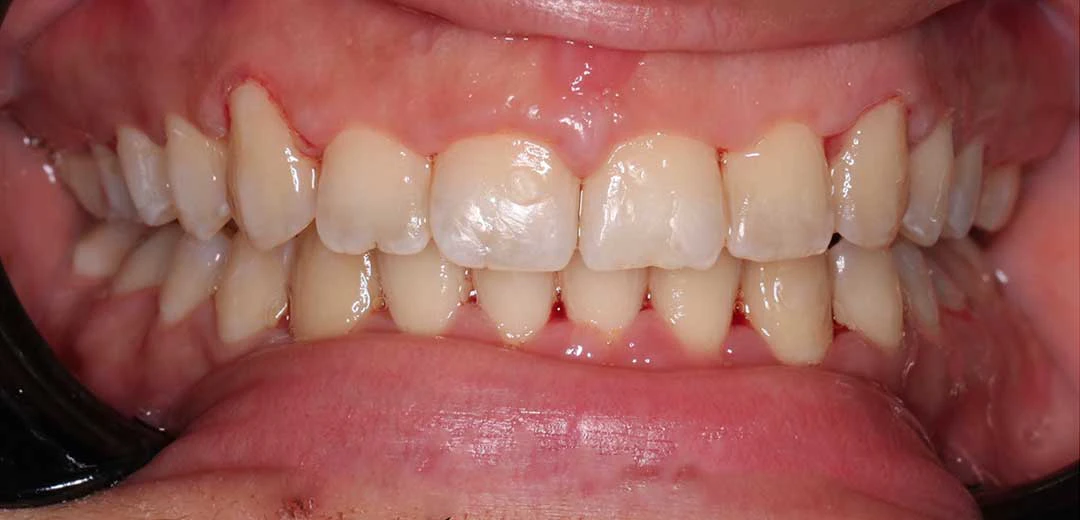 After treatment with braces