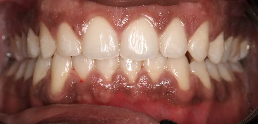 After treatment with braces