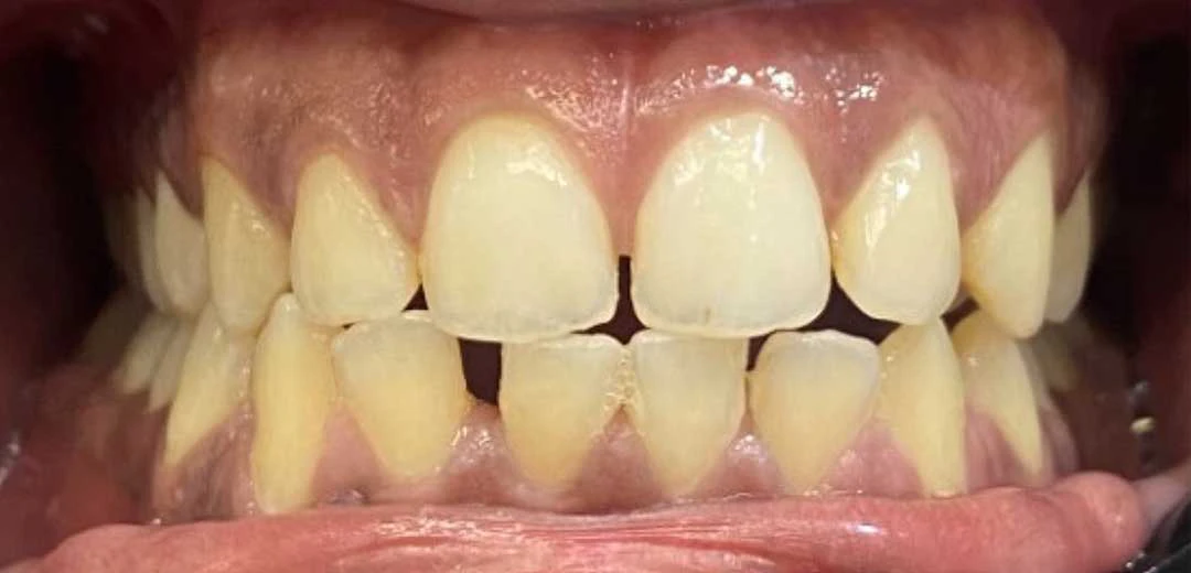 before treatment with braces