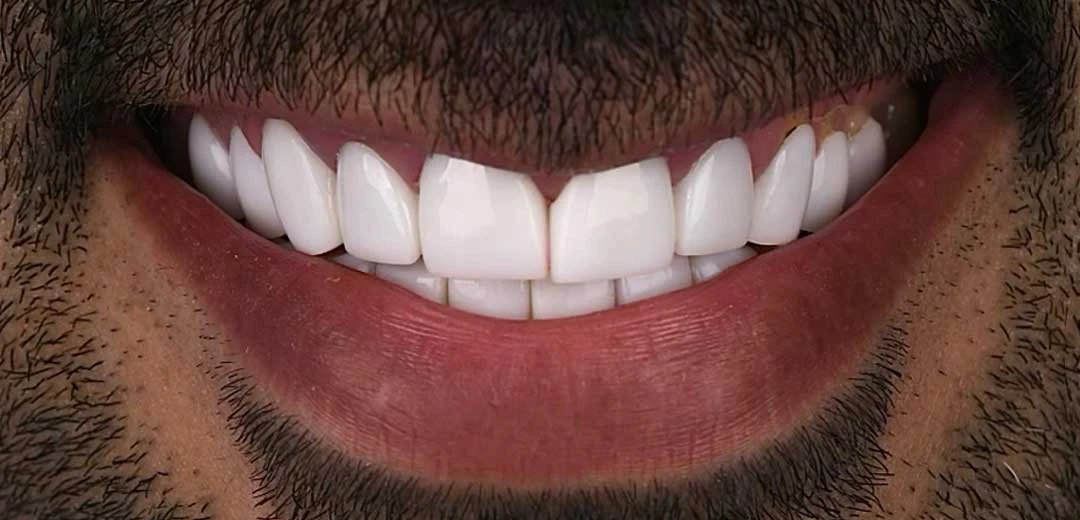 Before porcelain veneers