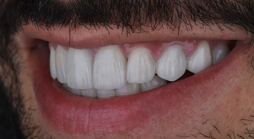 veneers in dubai