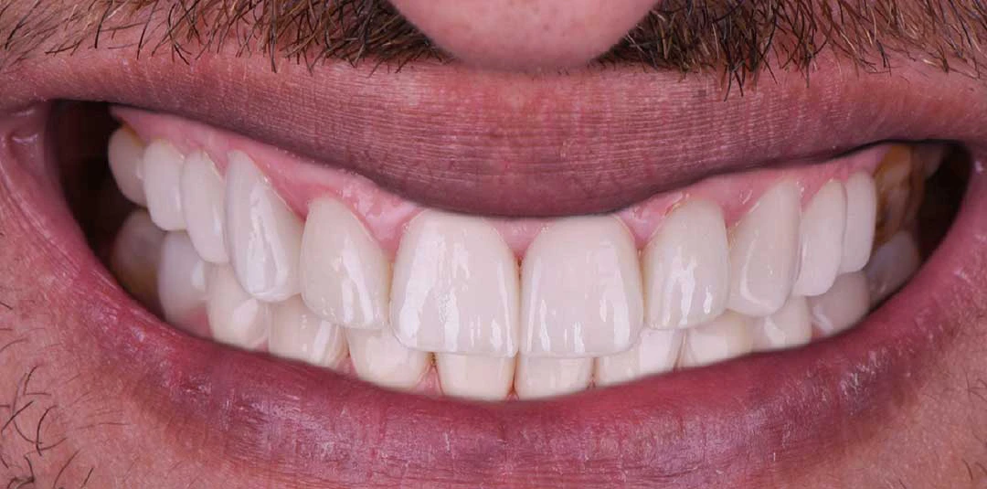 full mouth rehabilitation abu dhabi