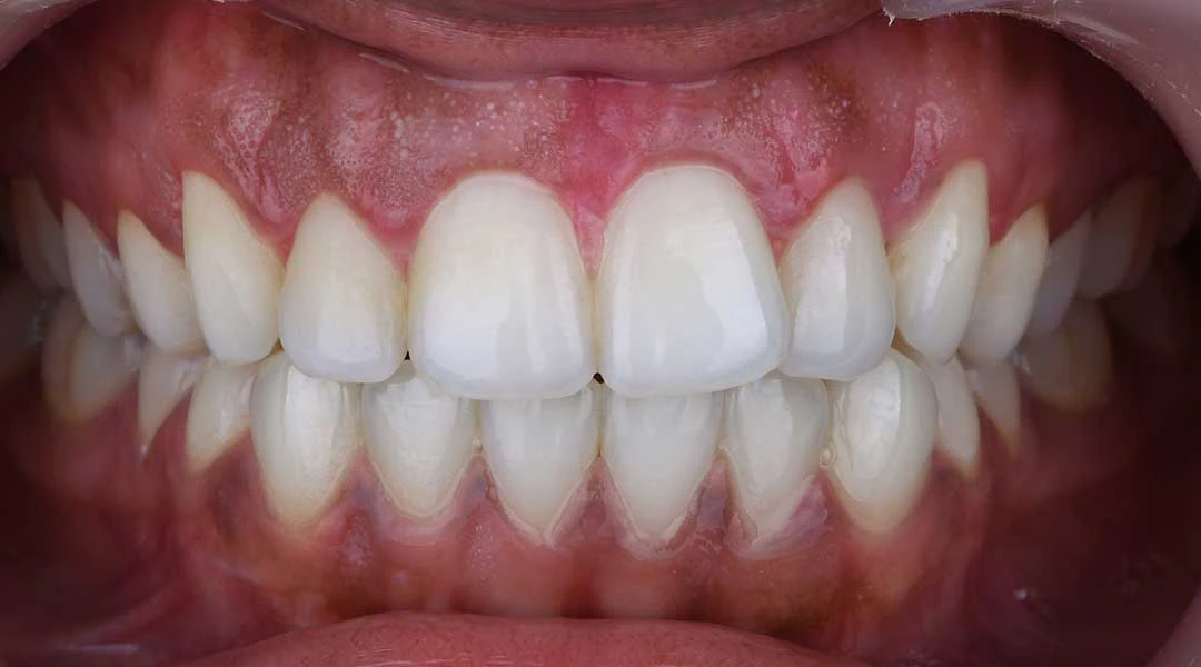 After Gummy Smile Treatment