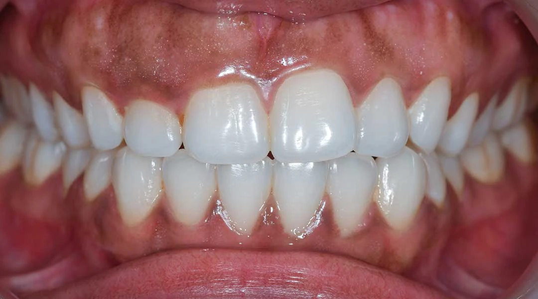 Before Gummy Smile Treatment