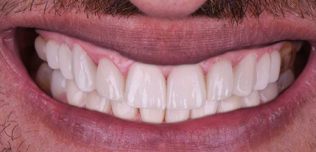 After dental implants