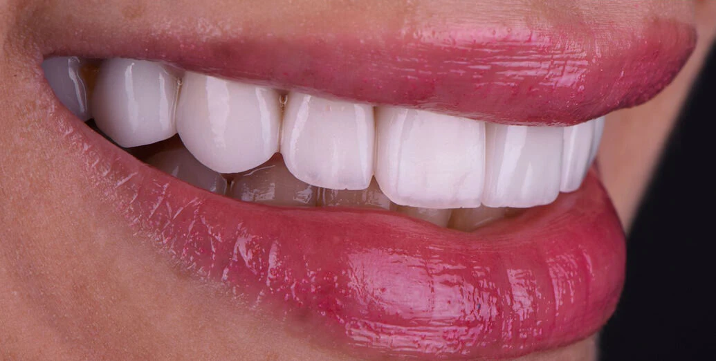 After porcelain veneers