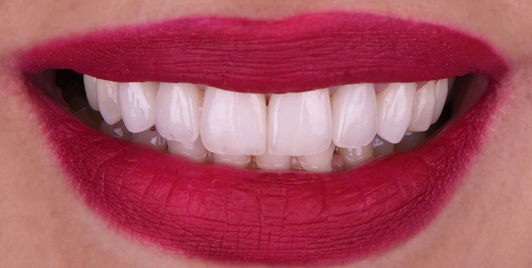 After porcelain veneers