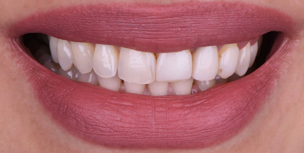 Before porcelain veneers