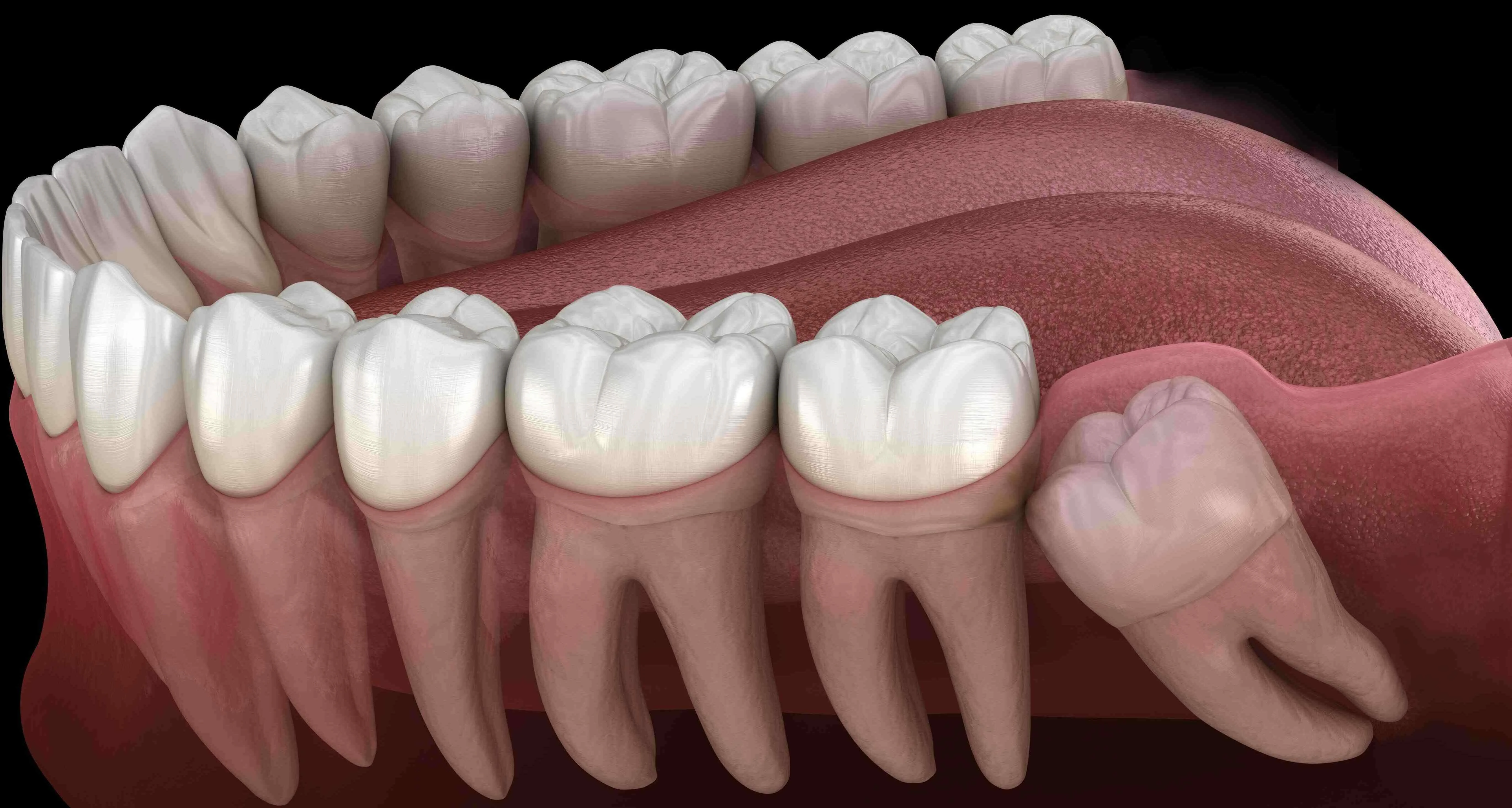 impacted wisdom teeth