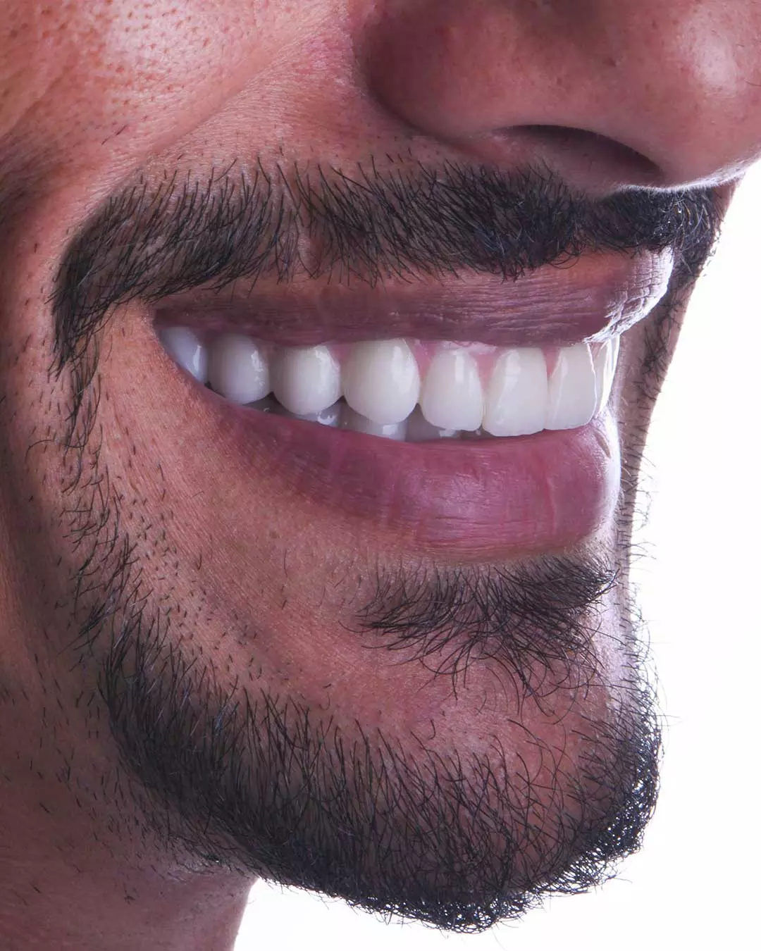 Close-up of a patient's mouth at Harmony Medical Center after dental implant treatment.