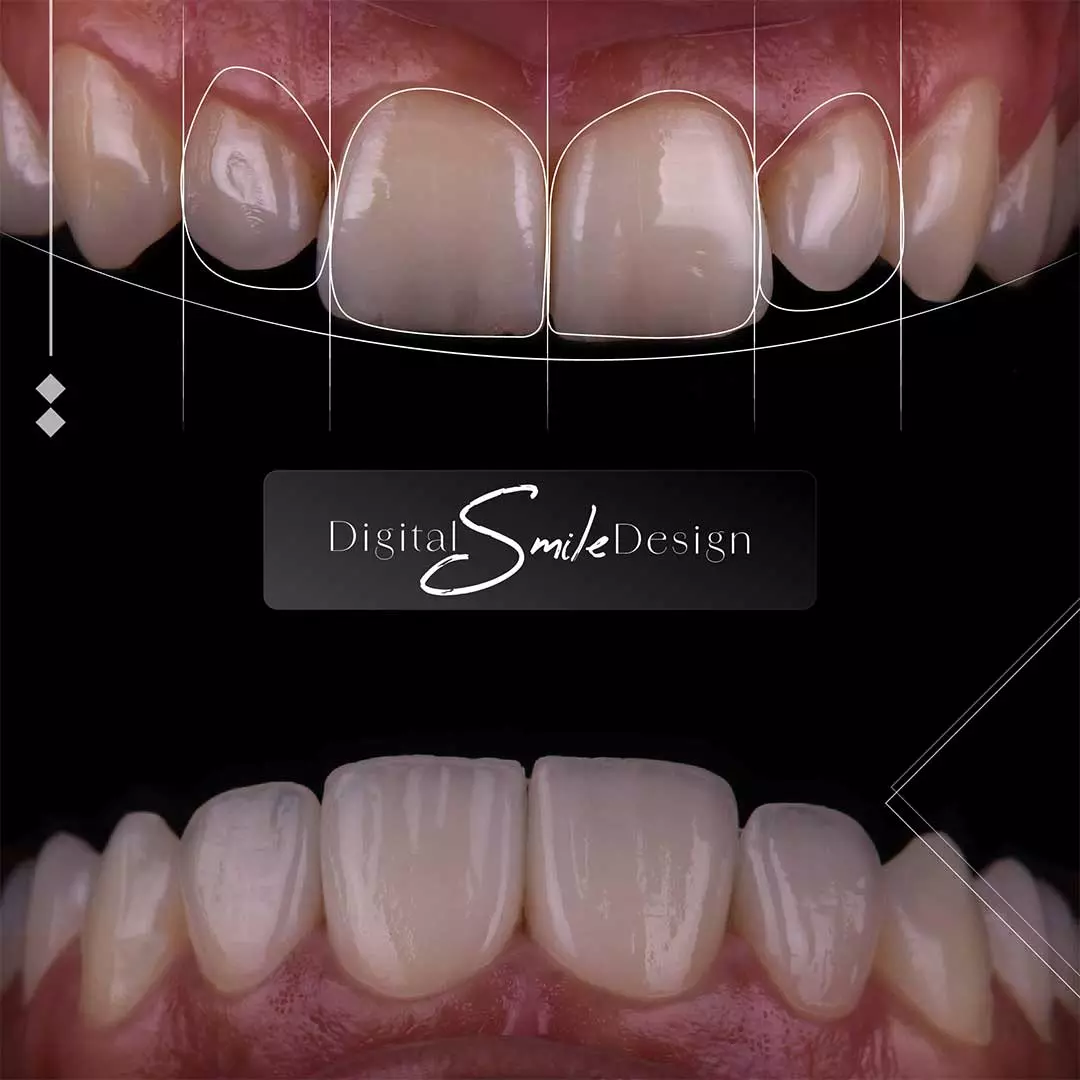 Before and after Digital Smile Design showing a full upper arch transformation with improved tooth shape and alignment.