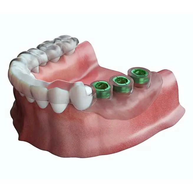 3D-Guided Implant Surgery