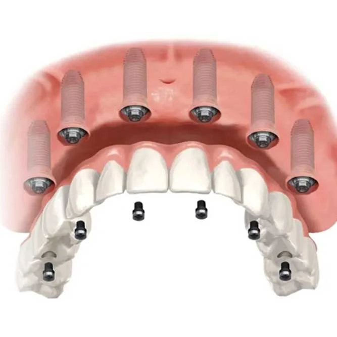 All-on-6 Dental Implants