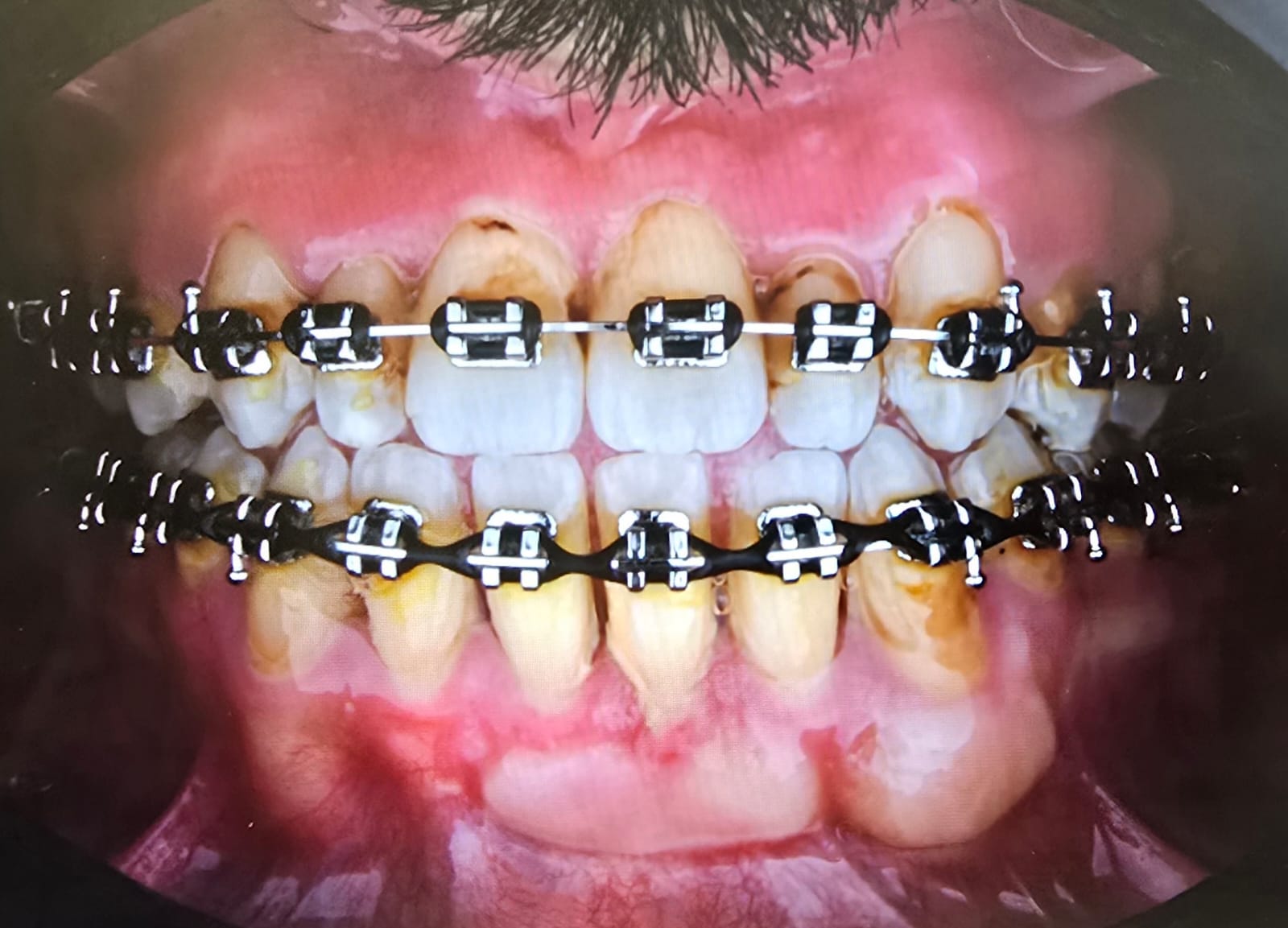 Before veneers treatment