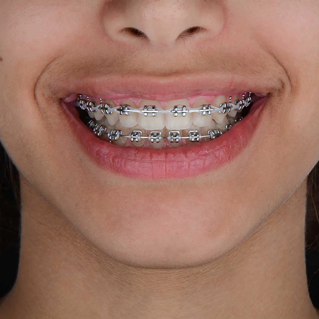 A closeup of a patient at Harmony Medical Center wearing braces