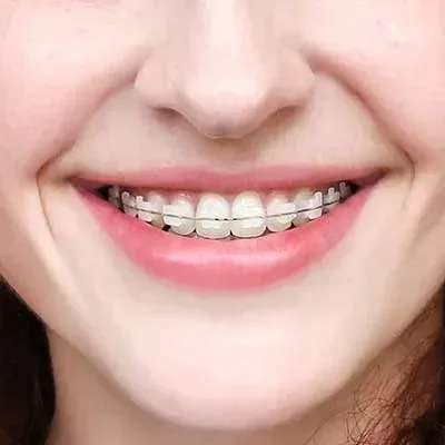 Ceramic Braces dubai