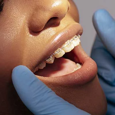 Ceramic braces close-up