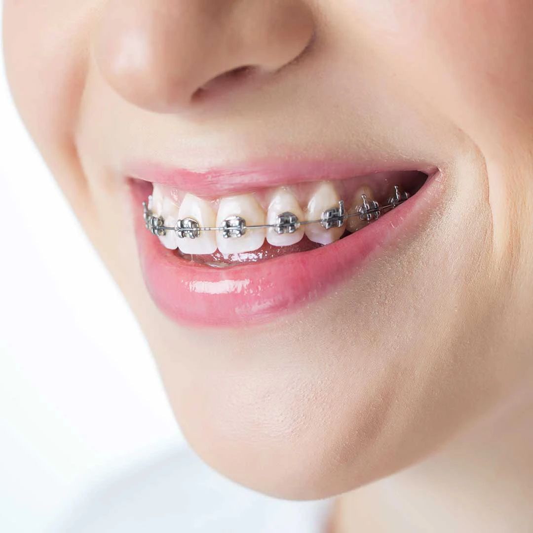 Self ligating braces icon