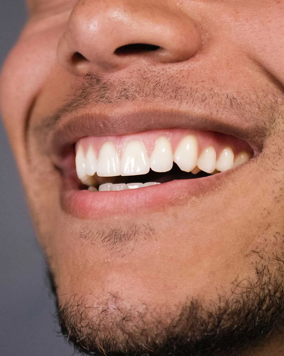 زراعة أسنان متعددة / جسر زراعة