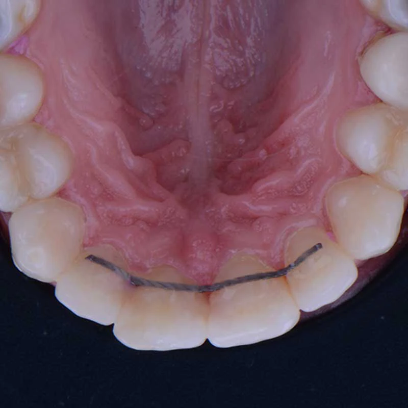 Fixed lingual retainers