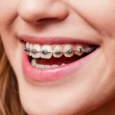 Metal Braces