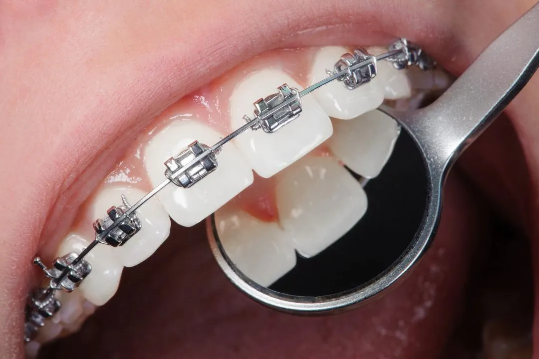 Traditional metal braces