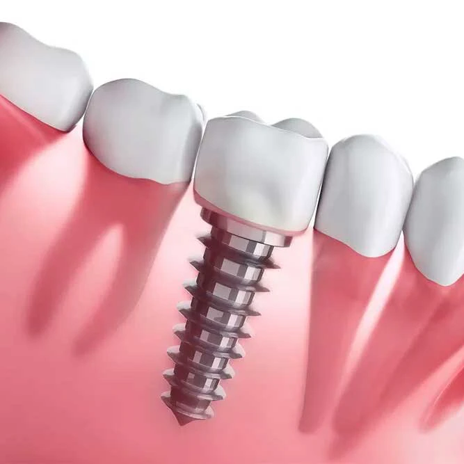 Same-Day Dental Implants