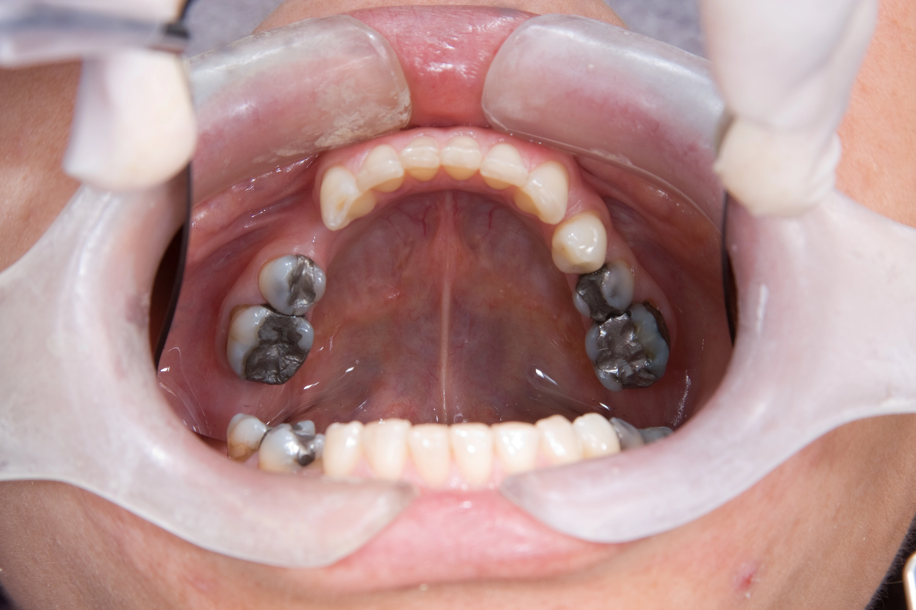 SMART amalgam removal in Jumeirah Dubai
