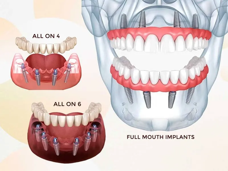All on 4 dental implants, full-arch fixed teeth on four implants