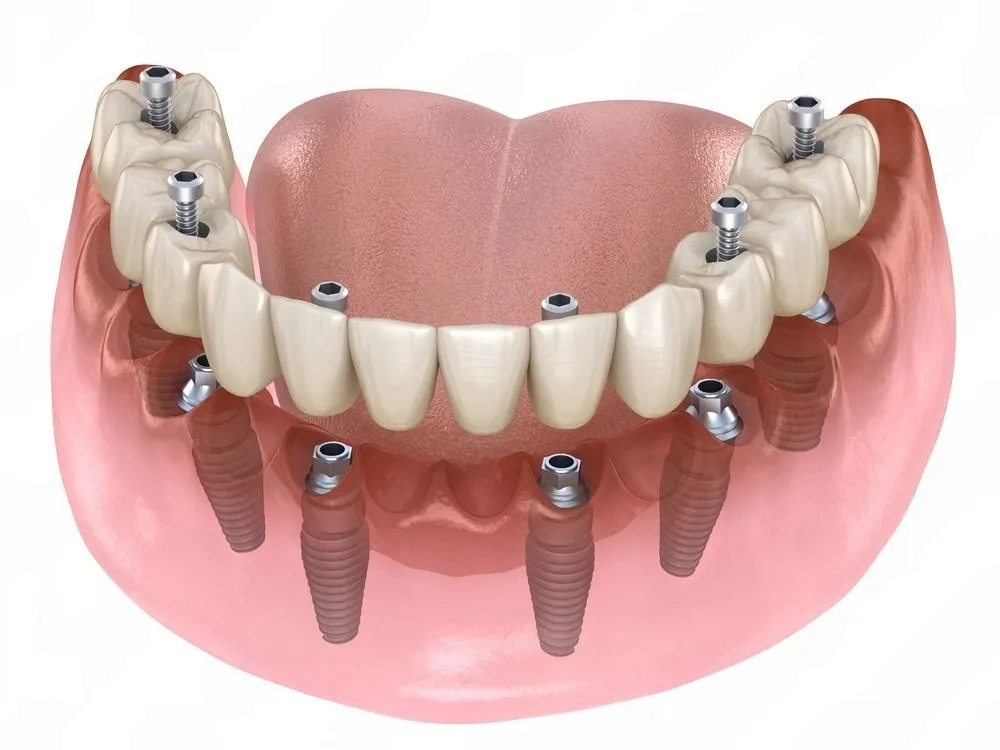 All-on-6 dental implants, full-arch fixed teeth on six implants