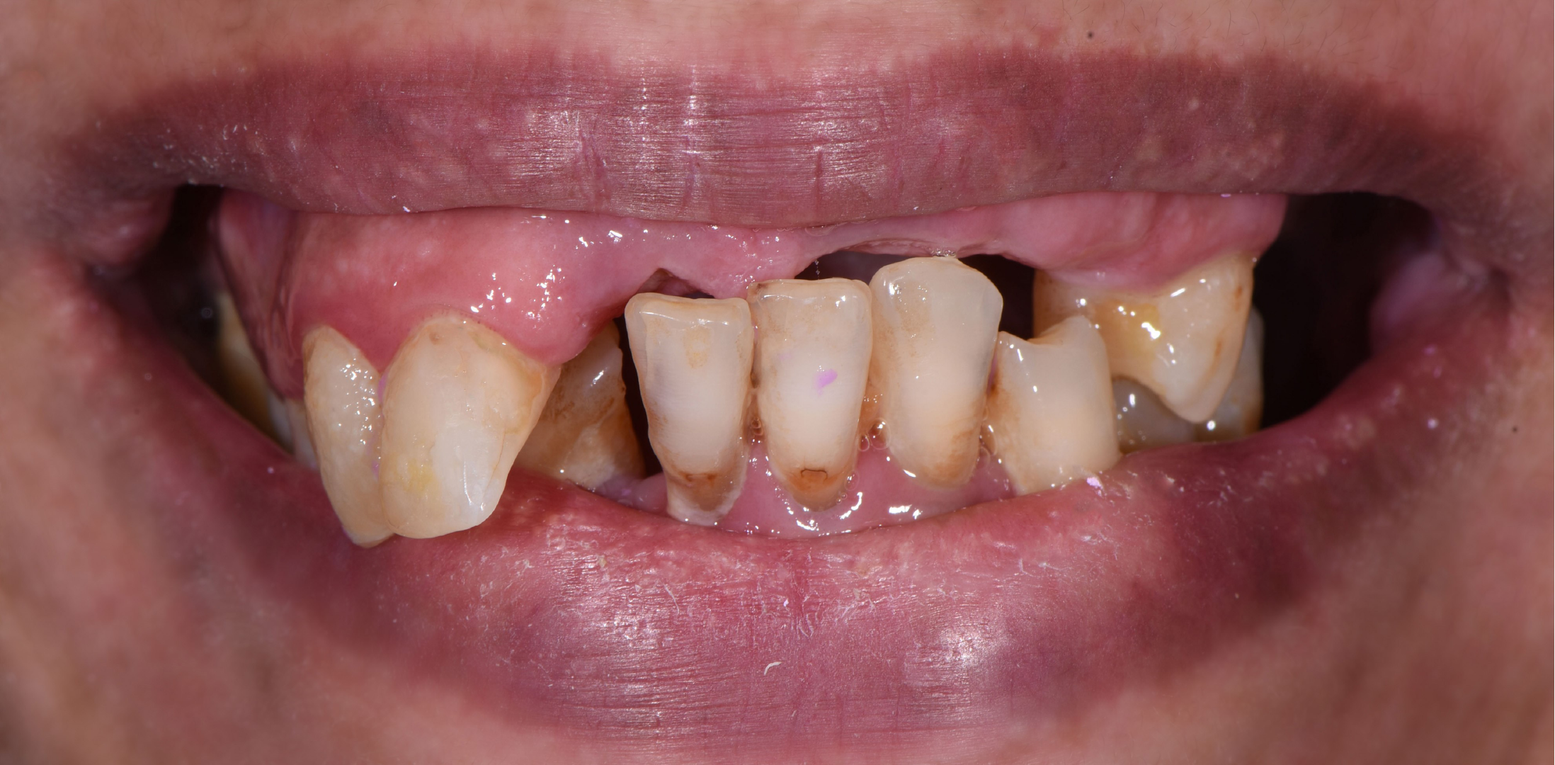 full set dental implants near me